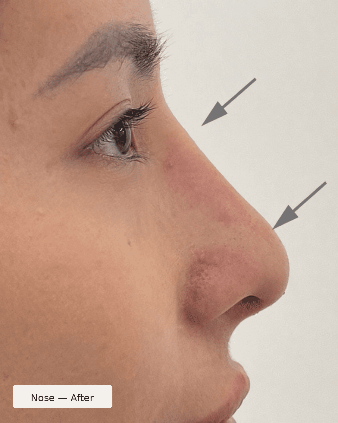 Nose Contour — After