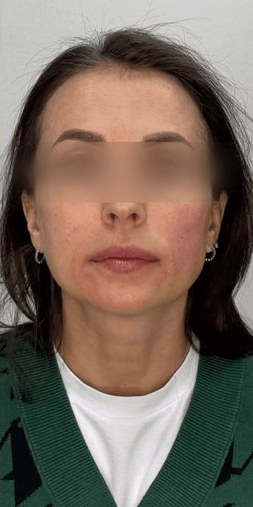 Facial Rejuvenation — After