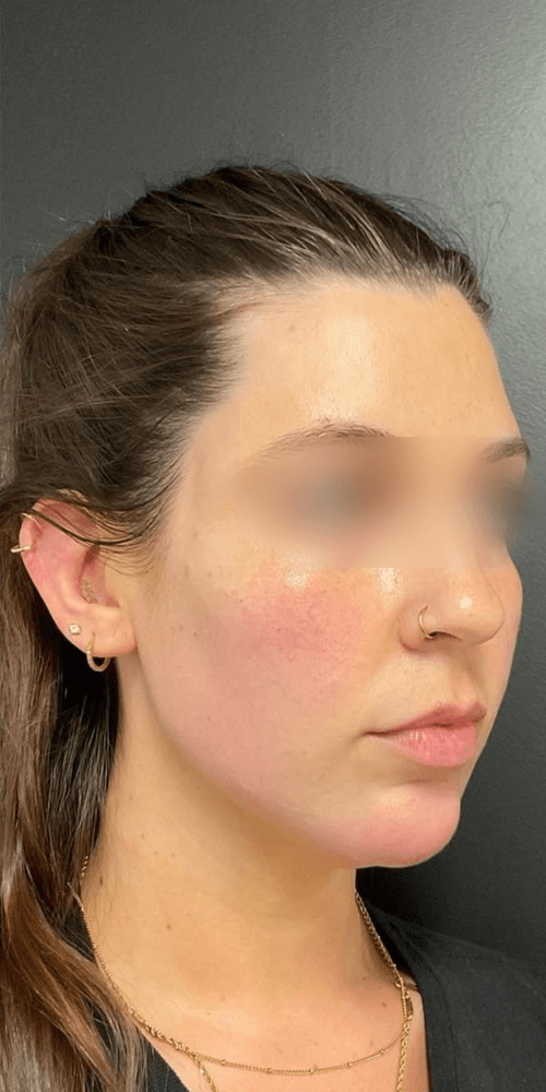 Jawline Refinement — After