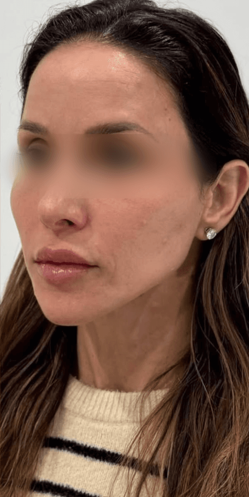 Midface Lift — After