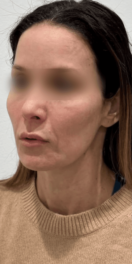 Midface Lift — Before